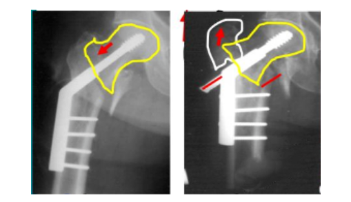 股骨粗隆间骨折PFNA内固定的4大关键