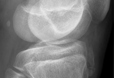 胫骨结节骨软骨炎的影像诊断