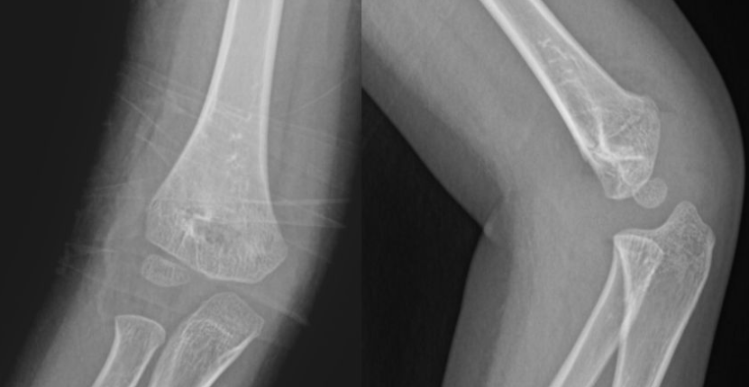 22个四肢骨关节外伤X线易漏诊病例