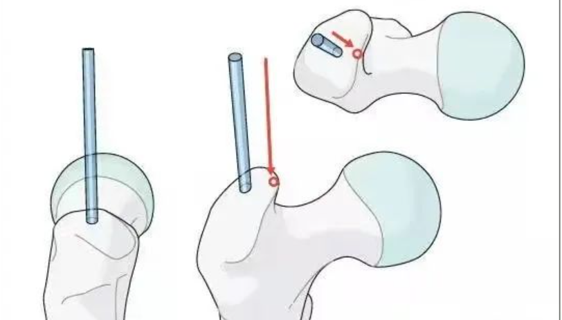 实战经验：髓内钉固定治疗股骨转子间骨折10条推荐（上篇 1-3）