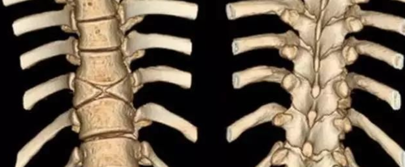 10种脊柱畸形影像表现汇总