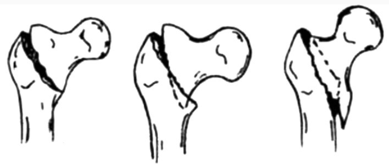 股骨转子间骨折常见分型