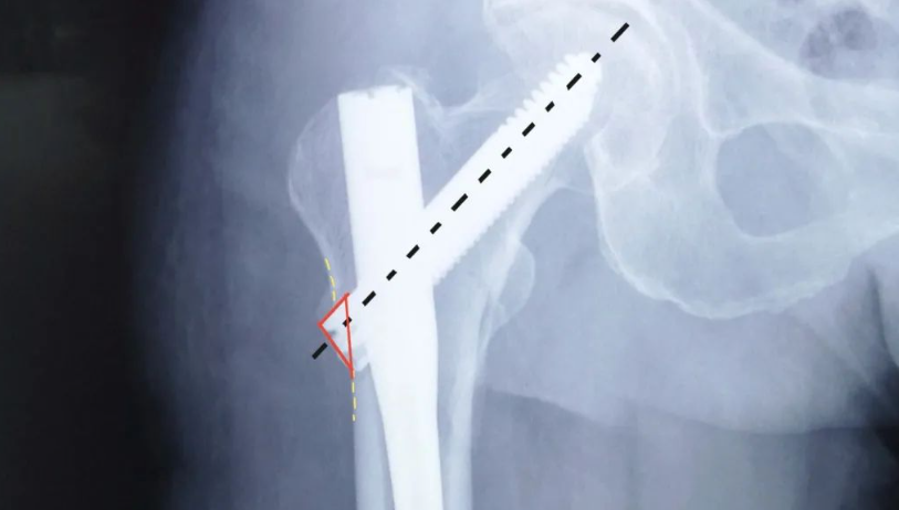 实战经验：髓内钉固定治疗股骨转子间骨折10条推荐（下篇 7-10）