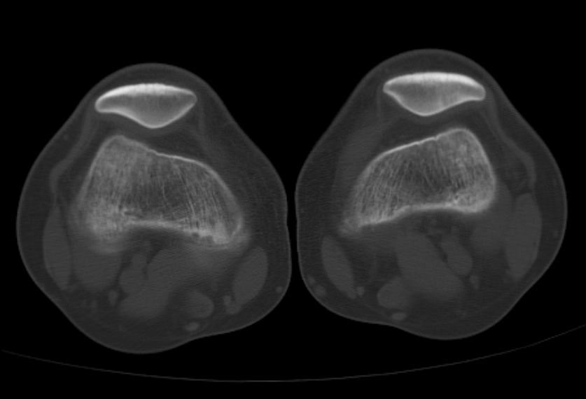 又学到啦！髌骨背侧的骨质缺损，原来是它！