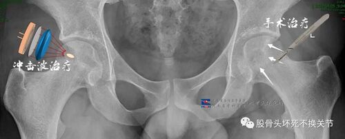 股骨头坏死如何选择治疗方案?