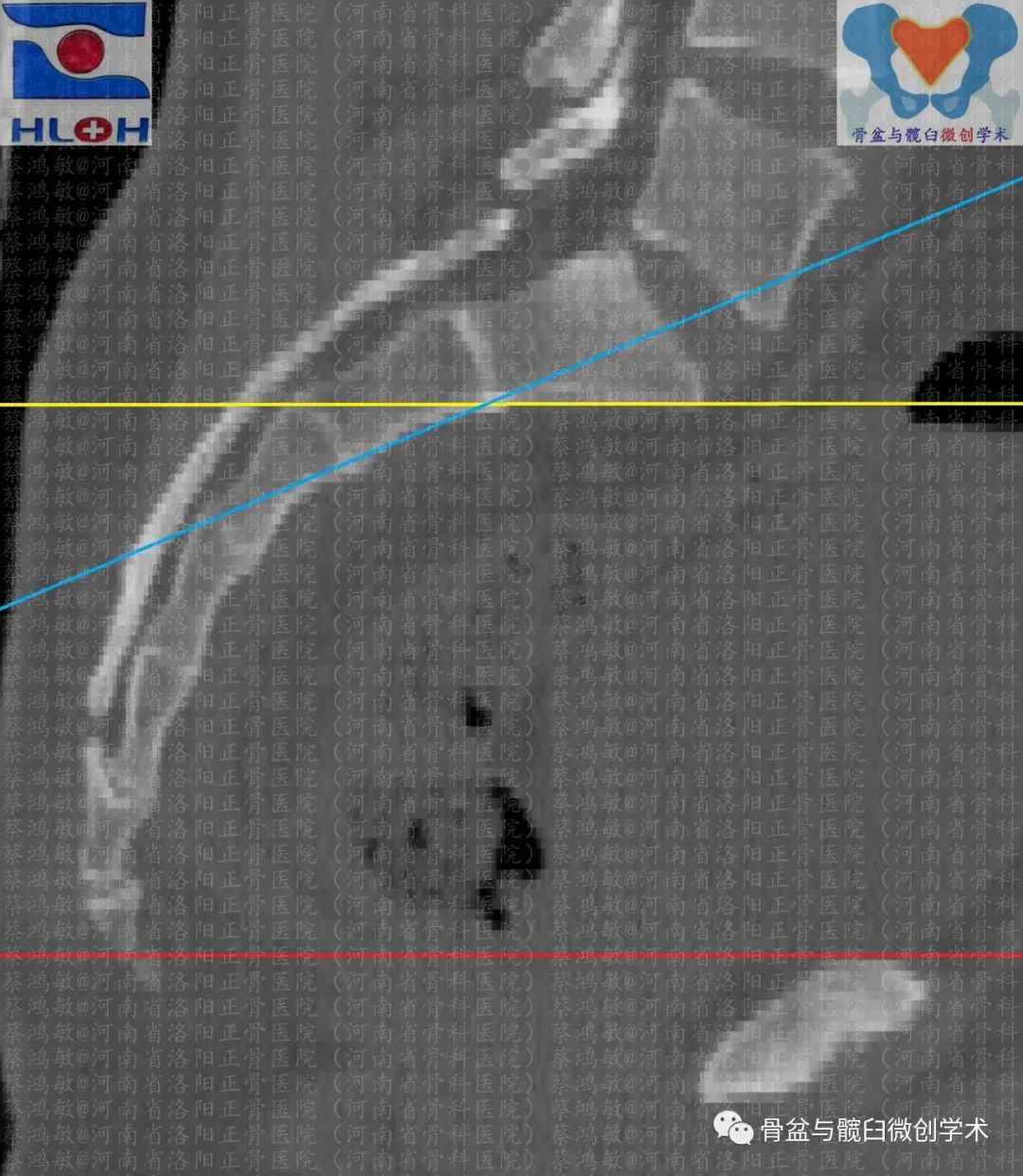提前量，不彷徨：让您轻松并精确掌控骨盆出入口位像