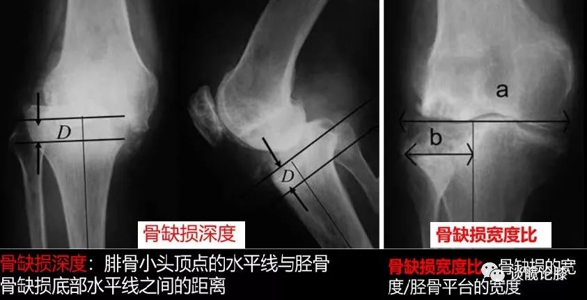 初次TKA胫骨骨缺损的处理