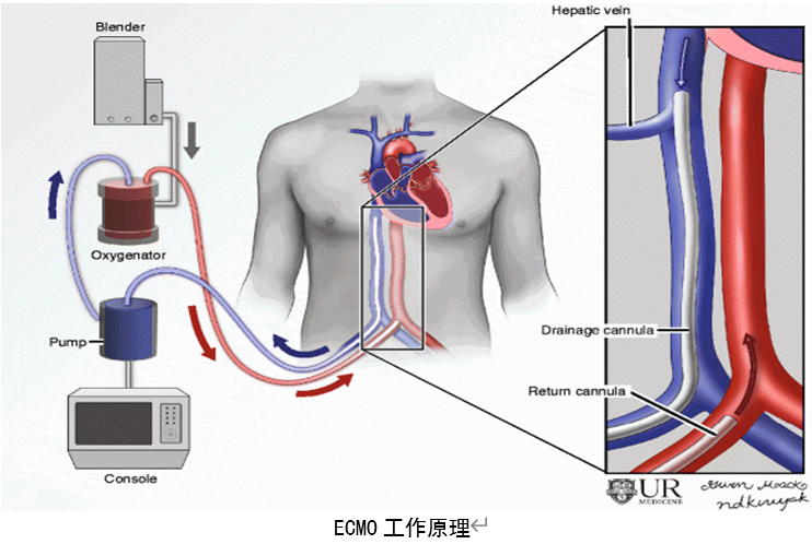 体外肺膜氧合系统(ECMO)最全攻略