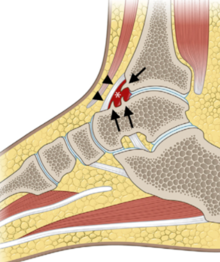 踝关节撞击综合征的影像表现、诊断与治疗