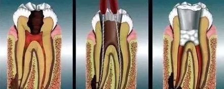 牙齿“晓”“技”| 根管渗血处理法