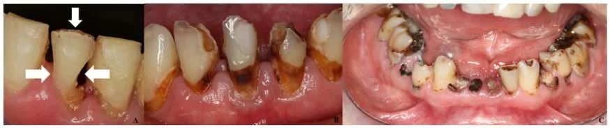 牙齿“晓”“技”|放射性龋齿的诊断、预后及管理规范