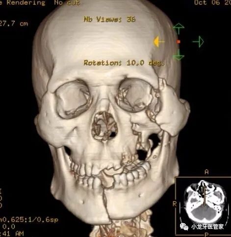 牙齿“晓”“技”|口腔急诊常见颌面部外伤处理