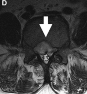 原发性脊柱感染的影像学诊断（二）：结核性脊柱炎和布氏杆菌脊柱炎