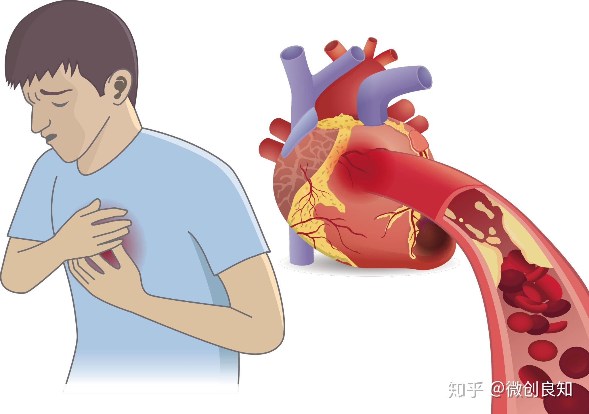 稳定性心绞痛与不稳定性心绞痛区别