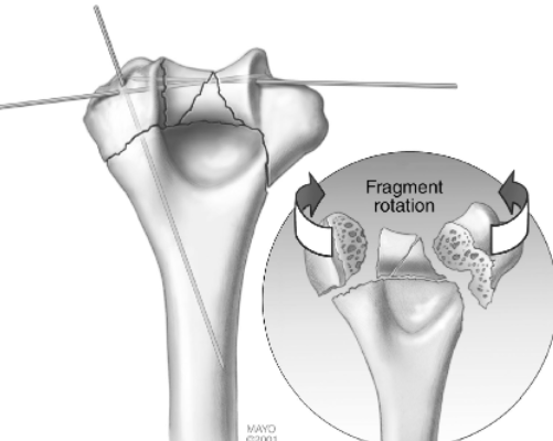 复杂肱骨远端骨折：基于“平行钢板技术”的内固定方法