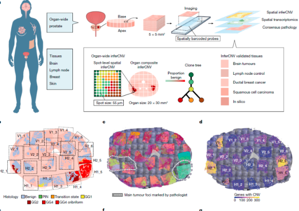基于空间分辨转录组学分析良、恶性组织拷贝数状态，揭示全基因组CNV的独特克隆模式