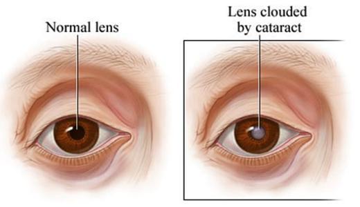 关于白内障的9个有争议的问题，你真的了解吗？