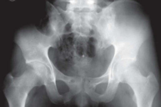 被称为“致命骨折”的骨盆骨折，如何快速准确诊断与评估？