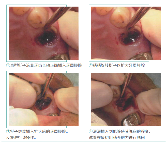 拔牙的细致流程详解