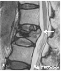 骨质疏松性椎体骨折保守治疗失败的危险因素分析
