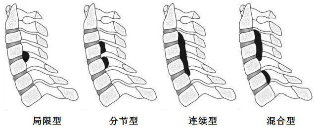 探究颈、胸后纵韧带骨化进展的因素差异