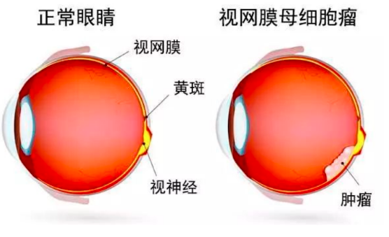 视网膜母细胞瘤到底是一种怎样的病？