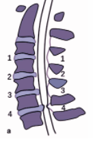 串联型椎管狭窄优先颈椎减压后腰椎症状复发的影像学预测因素