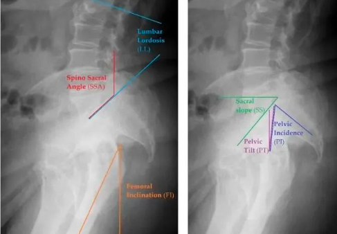 脊柱骨盆关系在全髋关节置换术中的应用