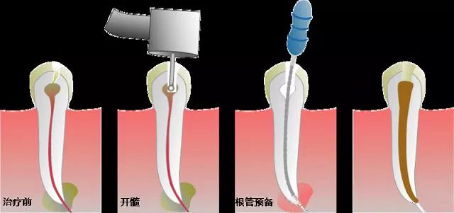 冷侧压和热牙胶充填的各自要点比较