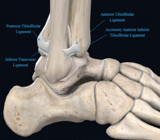  踝关节下胫腓联合损伤的诊治
