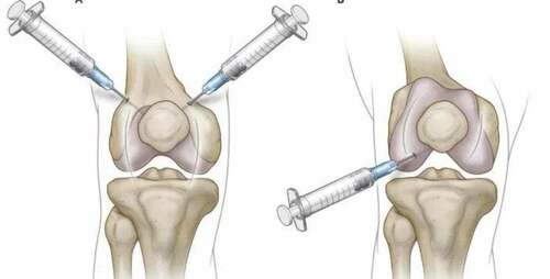 盘点膝骨性关节炎关节腔内注射药物治疗新进展