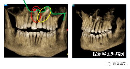 上颌多生牙鼻底入路拔除术