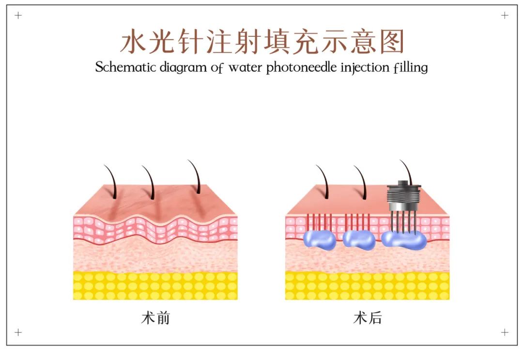 水光针操作注意事项