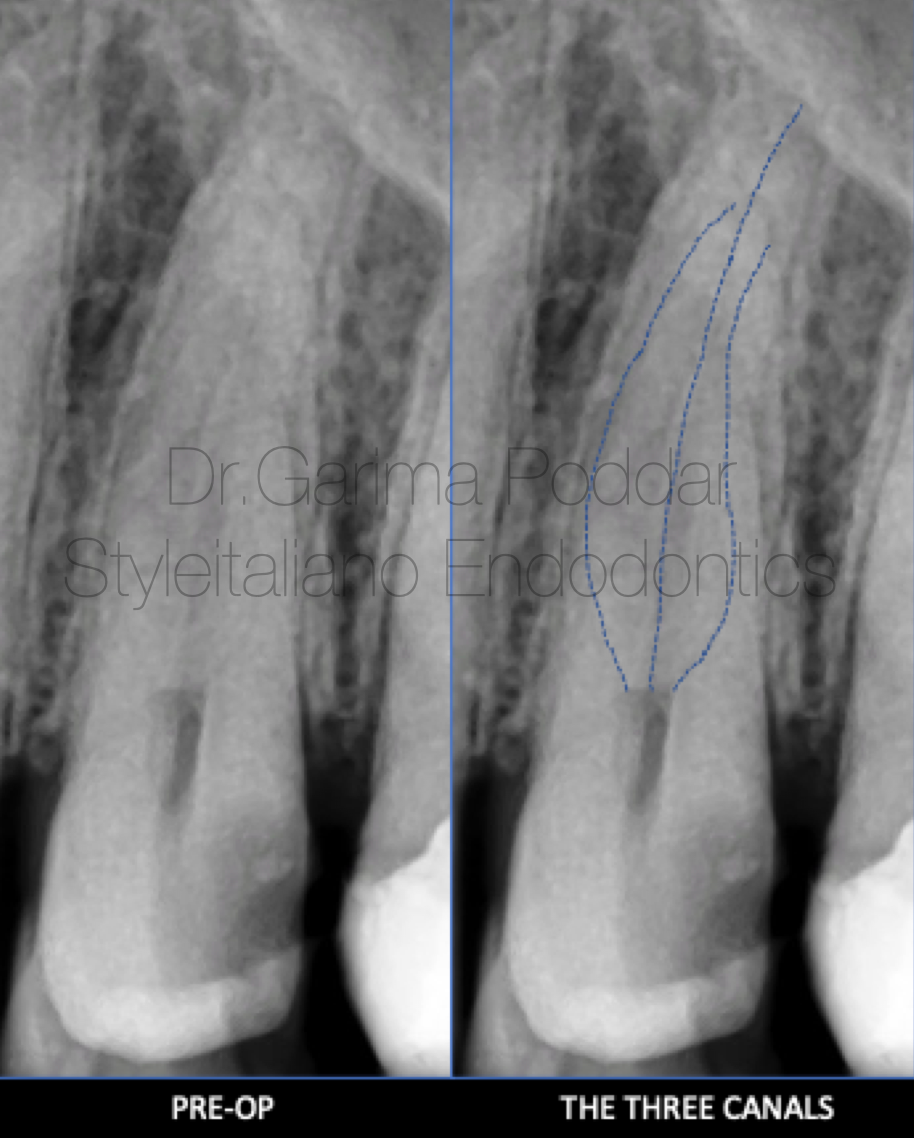 三根管上颌前磨牙的鉴别与治疗