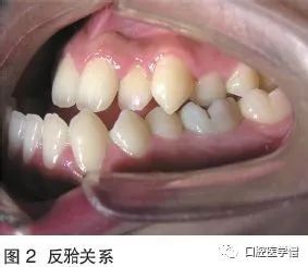 正畸案例：磨牙近中平移技术