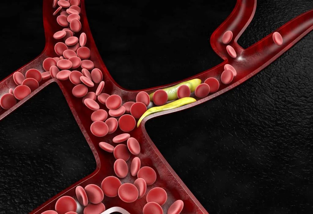 血管的硬化与钙化，哪个更严重？是怎样形成的？