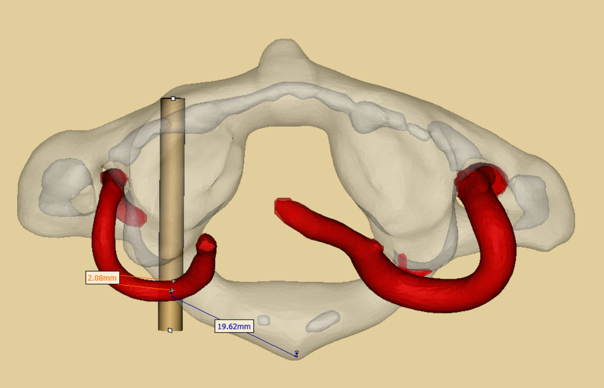 寰椎侧块螺钉内固定技术三维图谱