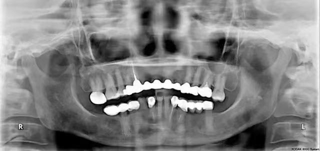 种植牙的治疗及修复的三个阶段