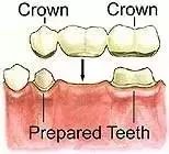 几种修复缺失牙的方法