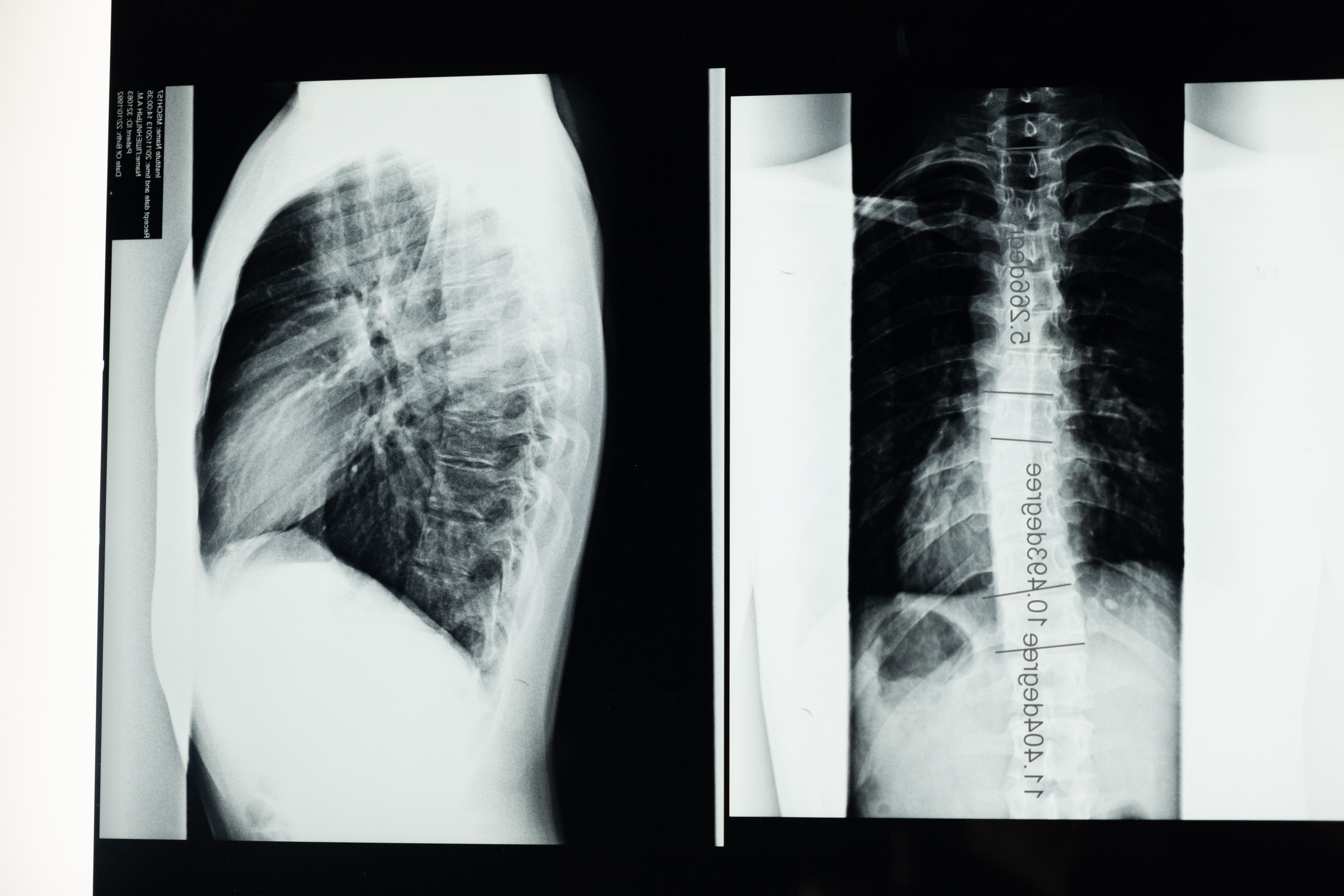 髋-腰综合征与脊柱骨盆矢状位生物力学关系