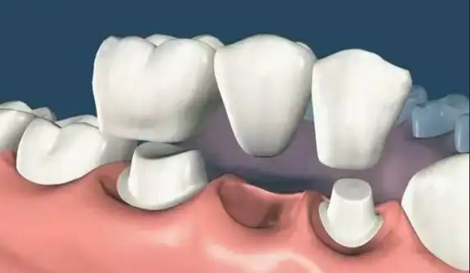 牙体缺损修复体类型的临床选择
