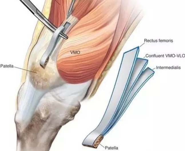 自体股四头肌重建前交叉韧带！各方面俱佳，你会用吗？