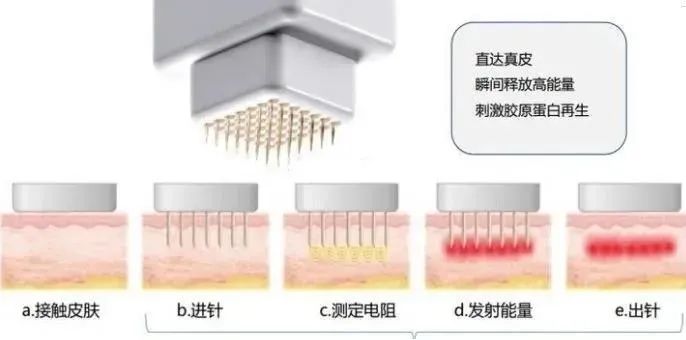 面部抗衰之黄金微针