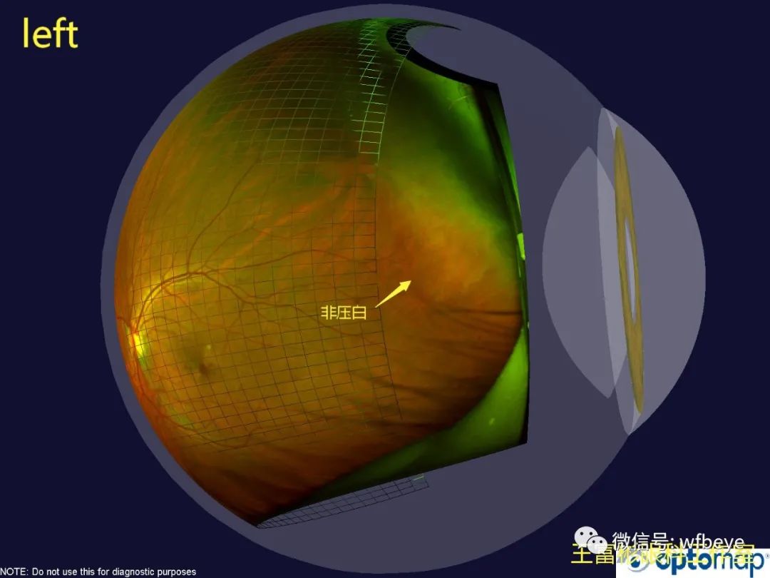 说说眼底“非压迫白”是怎么一回事