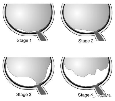 眼科早读 | OCT：“视网膜前间隙”相关的其中几种眼病