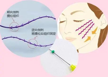 关于线技术面部提升术你了解多少?