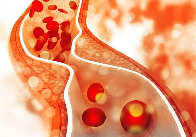 LDL-C >10 mmol/L，提示纯合子家族性高胆固醇血症！欧洲专家共识