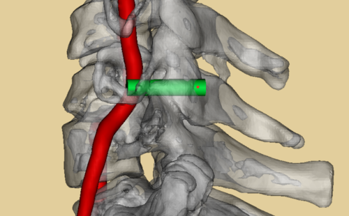 下颈椎侧块螺钉内固定技术三维图谱
