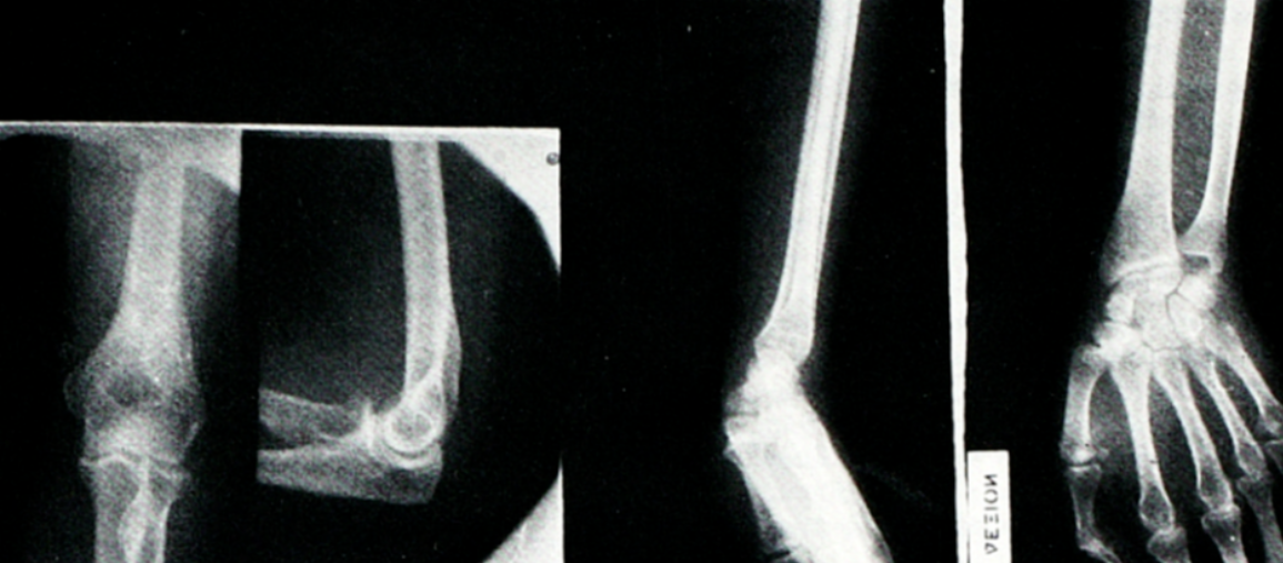 【临床经验】介绍一种新的前臂损伤三联征