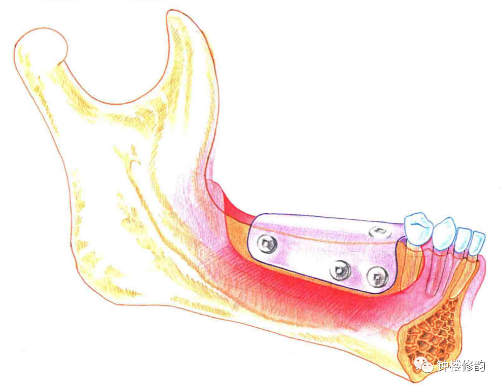临床常用的牙槽嵴垂直骨增量术